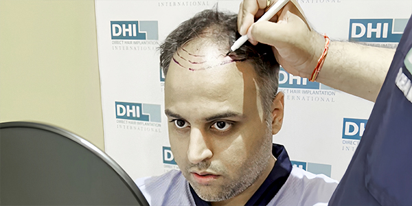 after hair transplant